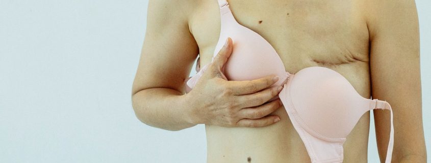 Mastectomy scars